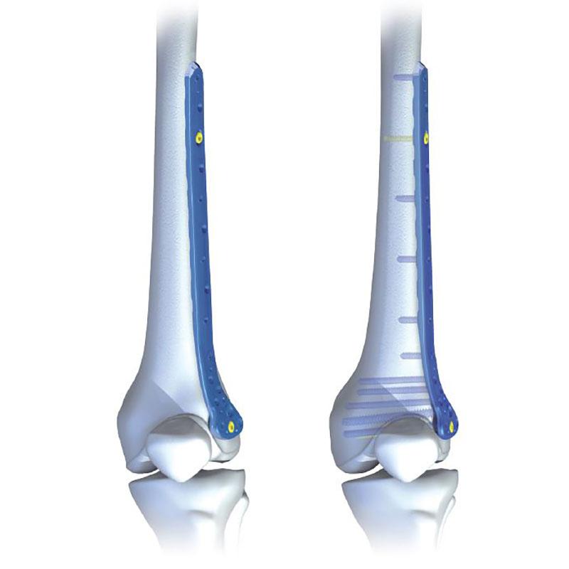 Пластина для дистального відділу стегнової кістки 7,0 ChLP